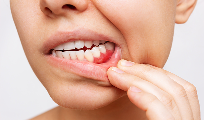 Woman holding her mouth in pain due to gum disease after making appointment at Covington Family Dental in Covington, WA